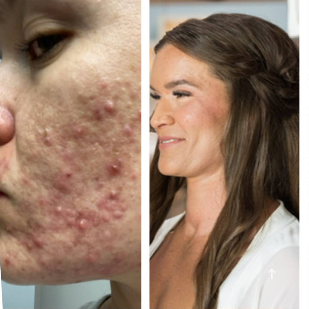 Before and after acne treatment results at Palm Beach Skin Co. in Loxahatchee